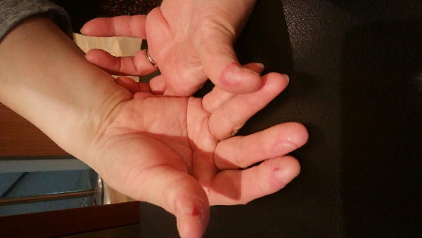 痛い痛い指先-191207-3.jpg